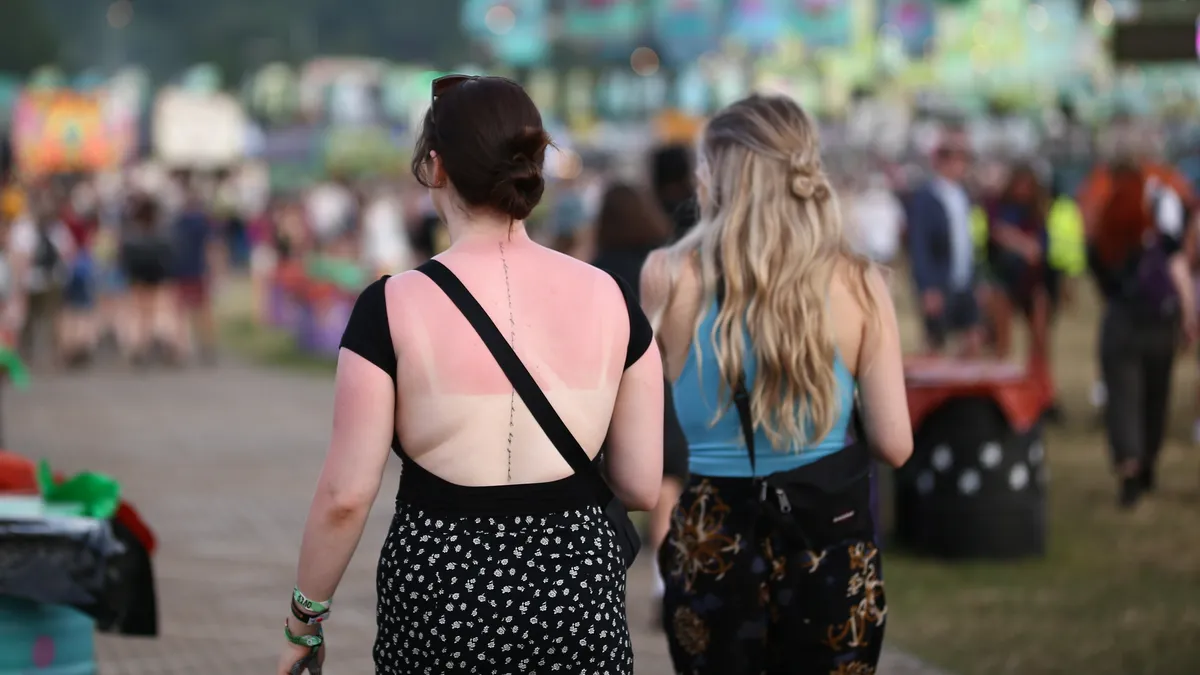 British experts give advice on adequately dealing with sunburns