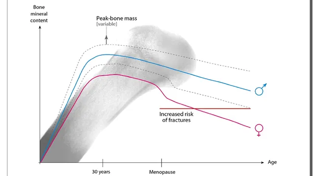 One in three women and one in five men suffer from osteoporosis worldwide