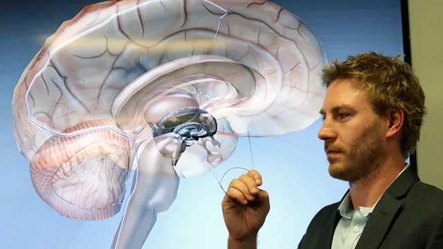 Scientists have created a brain implant that reads our thoughts